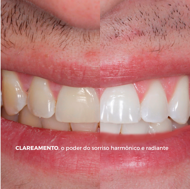 Clareamento Dental